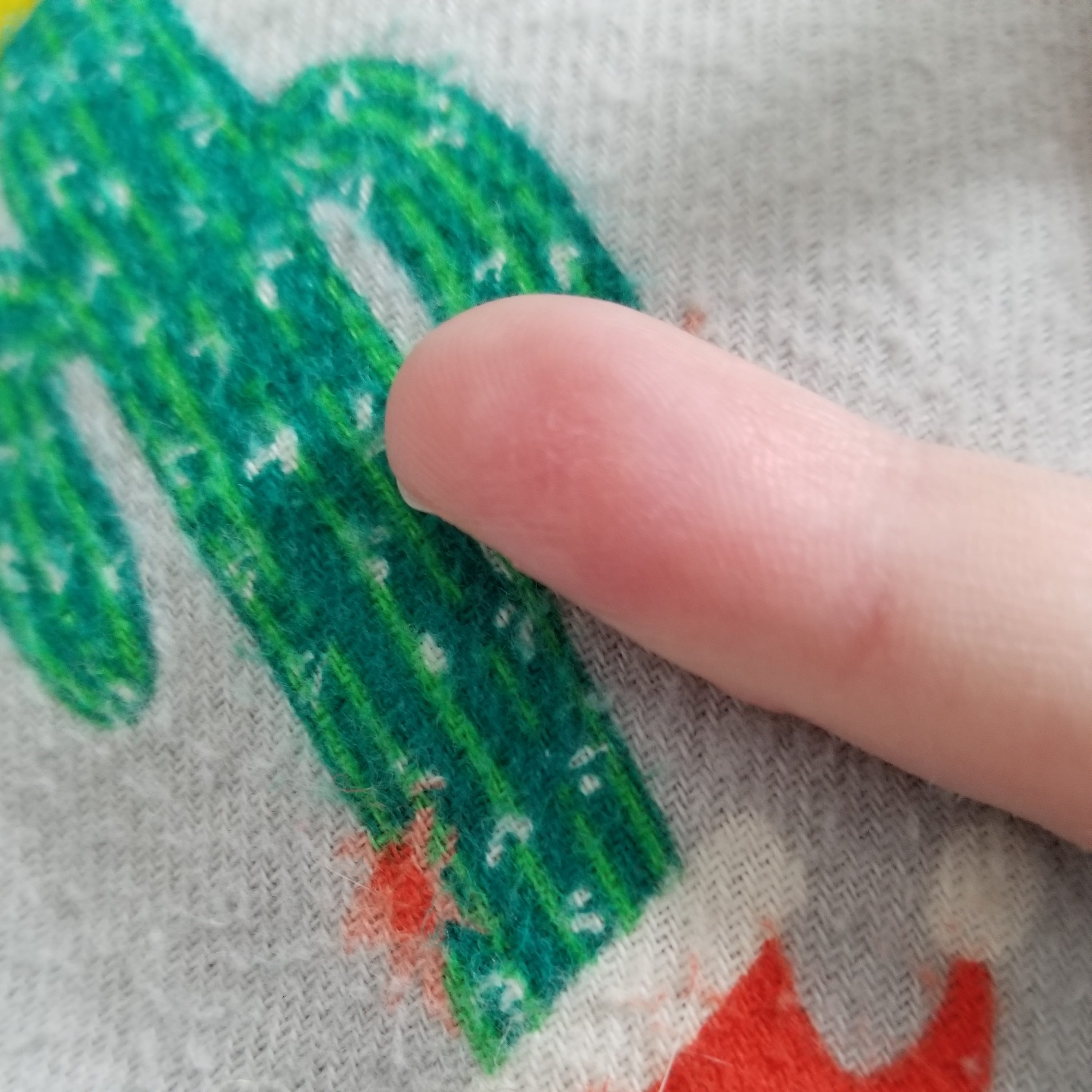 "This is about 2 months later. Its still pretty tender in the area and very effected by cold. I basically had super bad frostbite. The skin is a little rougher there as well. So that was my super fun, gross, bacon finger, wart removal journey!" When you look through this disgusting journey remember it started with a simple wart.