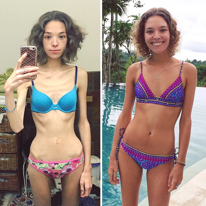 People Defeating Eating Disorders To Show You There Is Always Hope