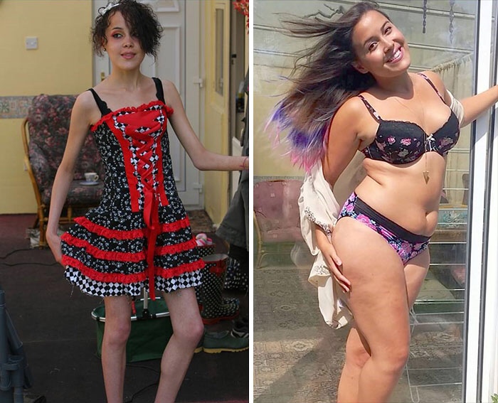 People Defeating Eating Disorders To Show You There Is Always Hope