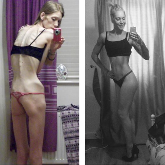 People Defeating Eating Disorders To Show You There Is Always Hope