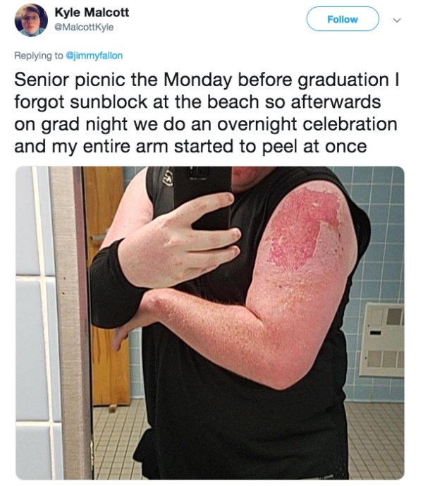 shoulder - Kyle Malcott Senior picnic the Monday before graduation | forgot sunblock at the beach so afterwards on grad night we do an overnight celebration and my entire arm started to peel at once