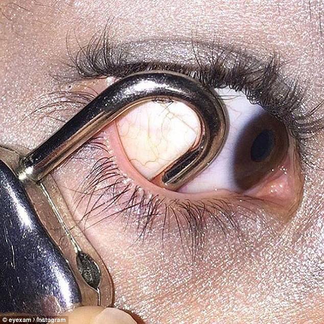 paperclip in eye