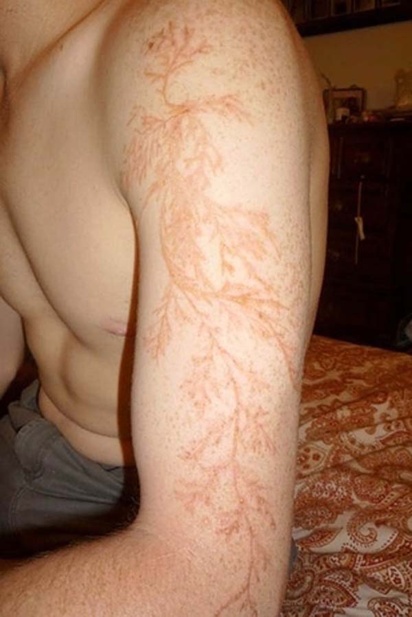 After getting struck by lightning, you can be left with this weird tattoo pattern.