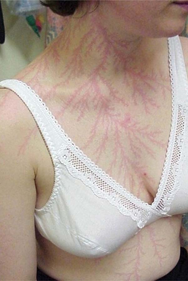 Its called a Lichtenberg figure, a temporary mark that consists of fractals.