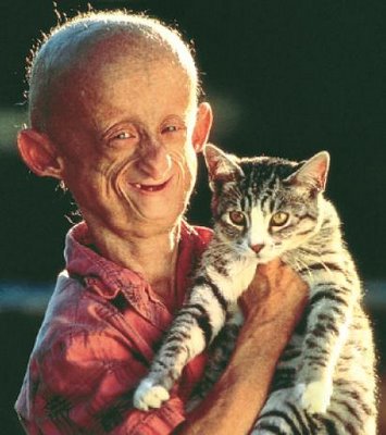 Progeria..