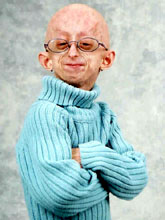 Progeria..