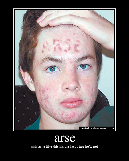 with acne like this it's the last thing he'll get