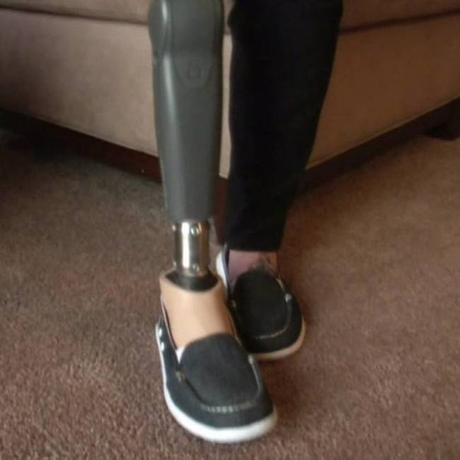 She is learning how to use her prosthetic leg.
