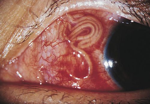 Some parasitic worms may take home in a human eye and feed on retina. They can be of microscopic size, or bigger.