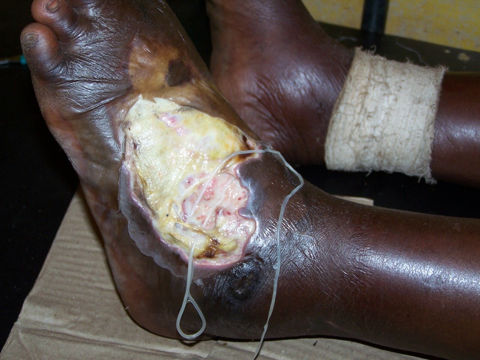 The Guinea worm can grow 2–3 feet inside the human. After it reaches that length, it burrows to the surface of the skin, creates a blister, and then emerges along with hundreds of thousands of larvae.