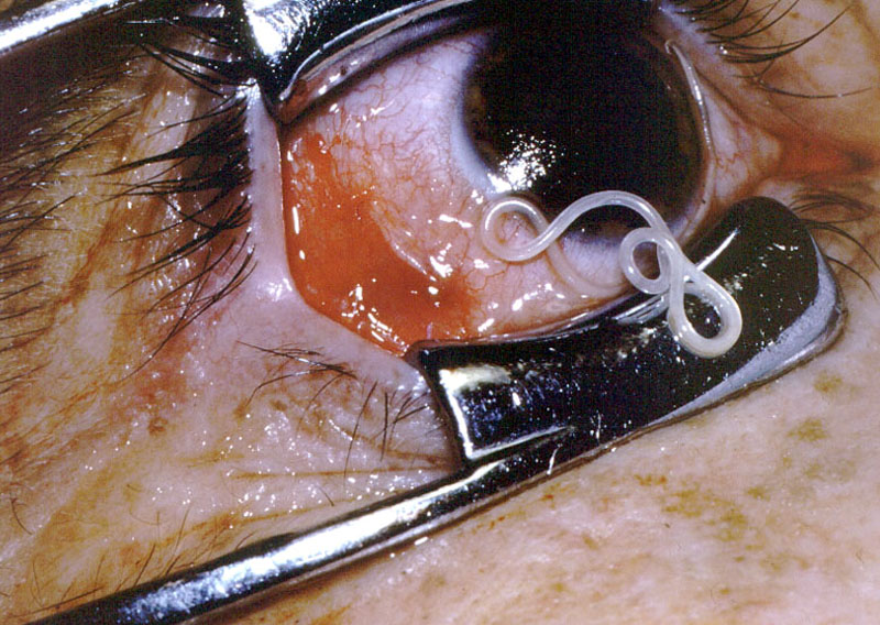 Loa loa, or “eye worm,” is a parasitic worm that lives in human and other mammal eyes. Creepily, a human can feel it moving around in his or her eye and may even seen the worm if its big enough. It can live inside a human for as long as 17 years.