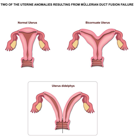 uterine didelphys - Two Of The Uterine Anomalies Resulting From Mllerian Duct Fusion Failure Normal Uterus Bicornuate Uterus Uterus didelphys