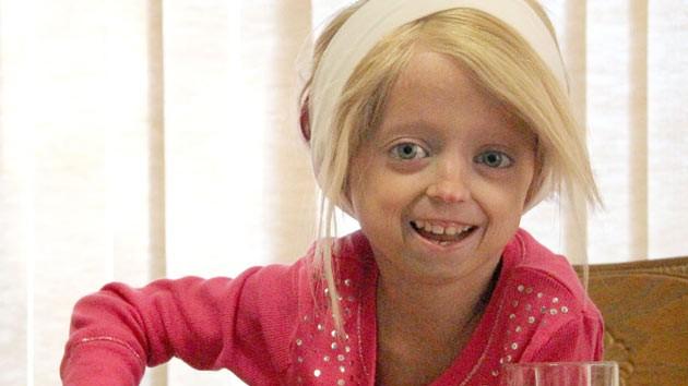 Progeria - Causes a child to look aged well beyond their years. It occurs in 

one in eight million births.