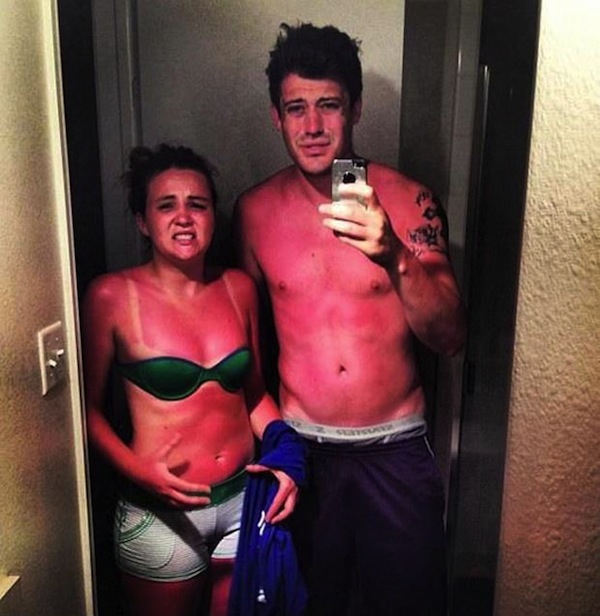 18 People Whose Vacation Got Ruined by Sunburn