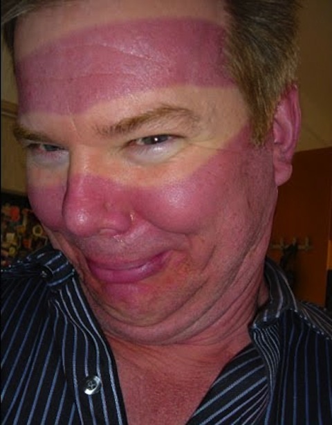 18 People Whose Vacation Got Ruined by Sunburn