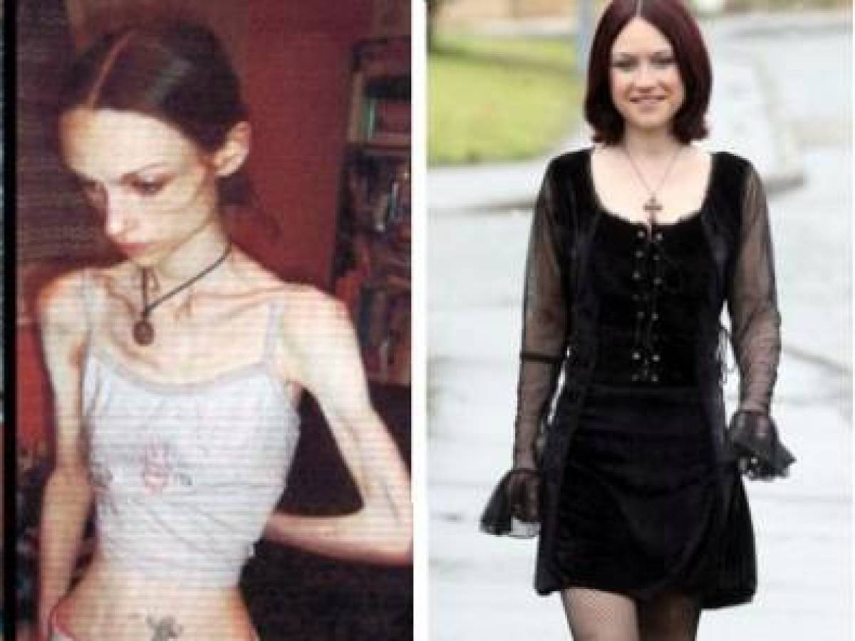 15 Amazing Girls Who Beat Anorexia