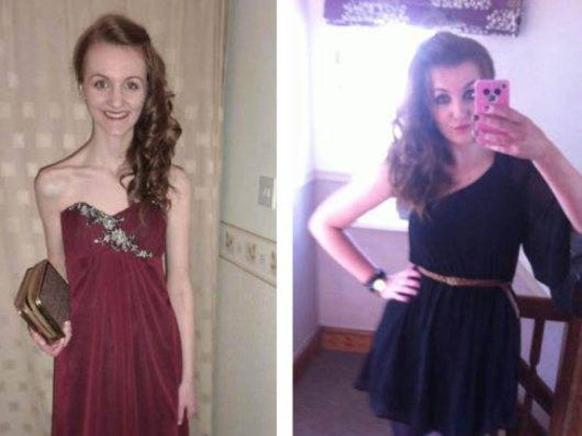 15 Amazing Girls Who Beat Anorexia