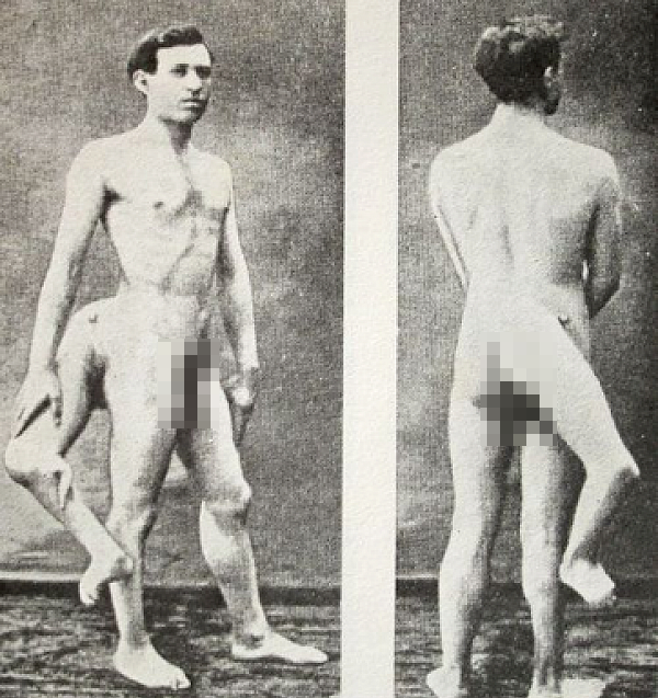 Francesco Lentini had 3 legs. When he was a child, he hated his extra 

limb, which was the cause his family sent him to live in a home for 

disabled children. It was there where he gained his lust for life, 

embraced his disfigurement, and turned it into a merit, joining circus.