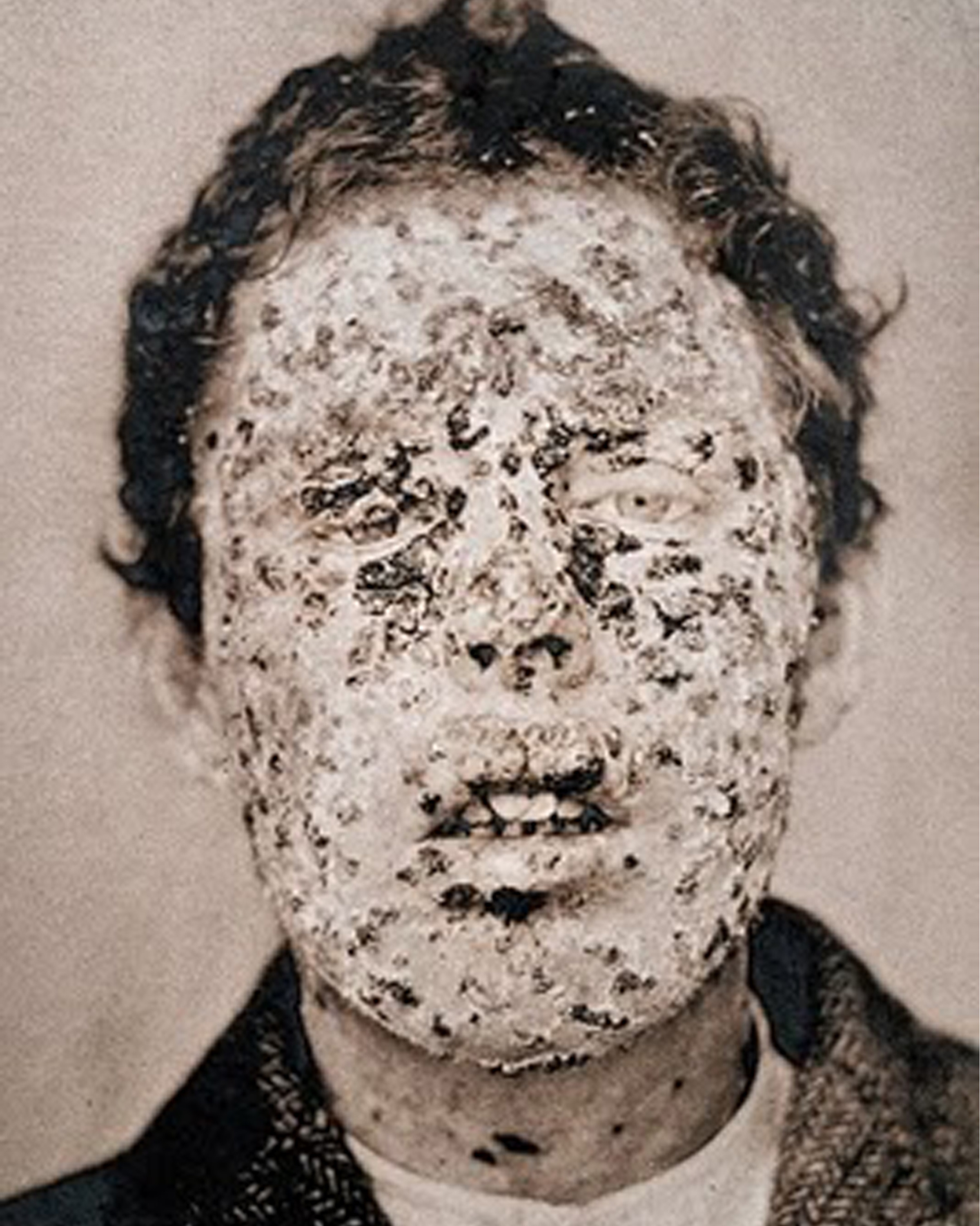smallpox during the civil war