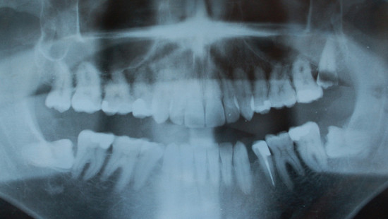 Although wisdom teeth are now simply painful and frail, they once served a very important purpose. A long, long time ago, pre-humans were primarily herbivores, which meant they ate a lot of greens. Because green vegetation takes longer to digest, it needed to be chewed more, and wisdom teeth gave the extra surface area needed to grind the greens into pulp.