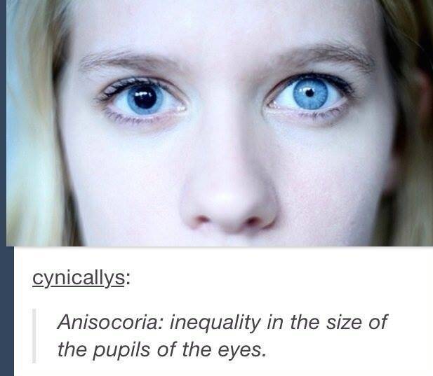 unequal pupil size - cynicallys Anisocoria inequality in the size of the pupils of the eyes.