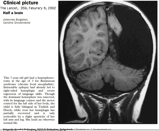 Hemispherectomy is a very rare surgical procedure where one cerebral 

hemisphere (half of the brain) is removed or disabled. This procedure 

is used to treat a variety of seizure disorders.