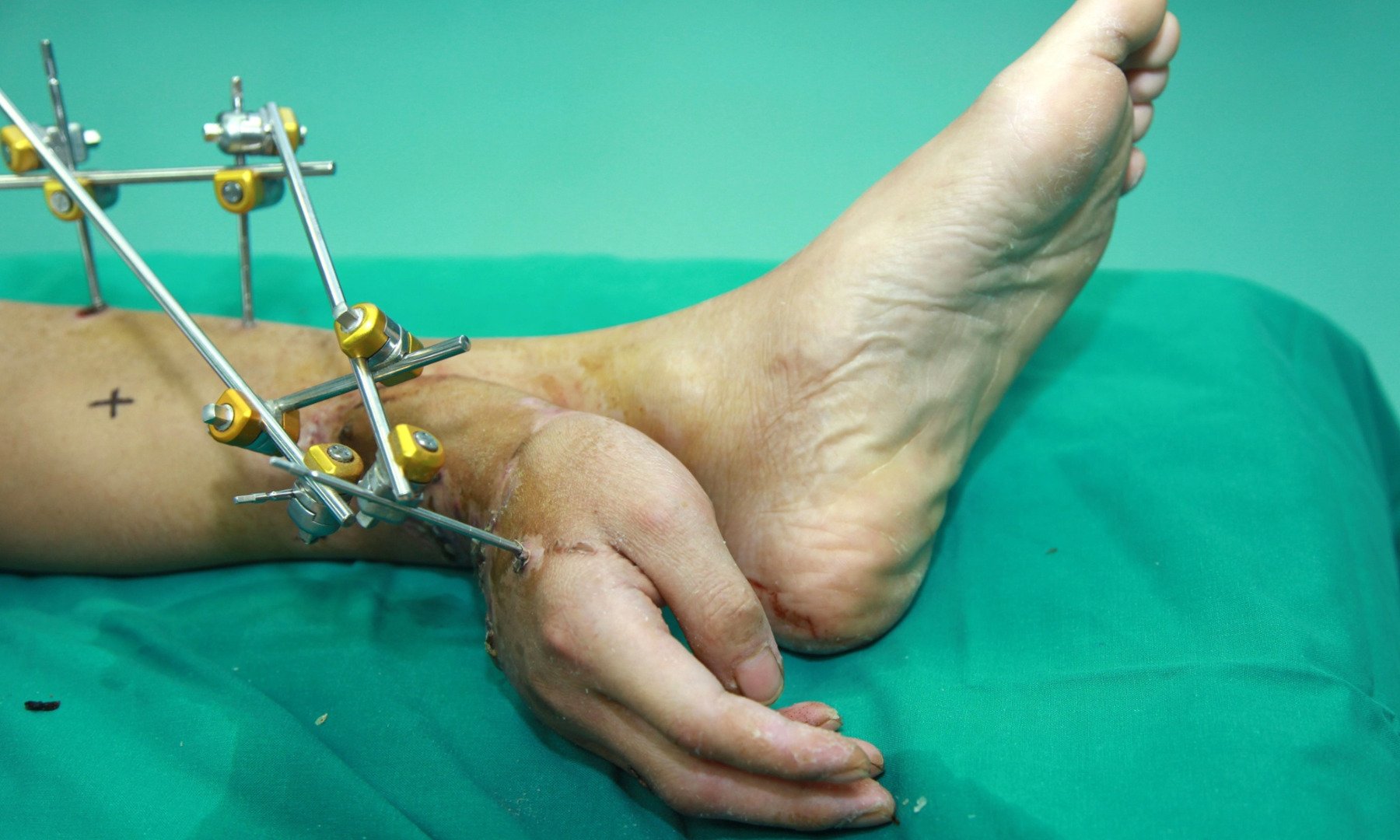 In China there's a procedure that saves a limb that's been severed 

off. The doctors attach it to the patient's leg, to let it recover, 

and after the severe injury is healed enough to allow a proper 

transplant, it is possible to reattach it to its original place.