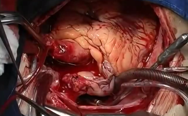 Patient Tyson Smith, 36, was suffering from heart failure but was too 

weak to have a traditional heart transplant.
So surgeons at the UC San Diego's Thorton Hospital left Mr Smith's 

own heart in place and implanted a second donor heart next to it, 

which they then fixed together.