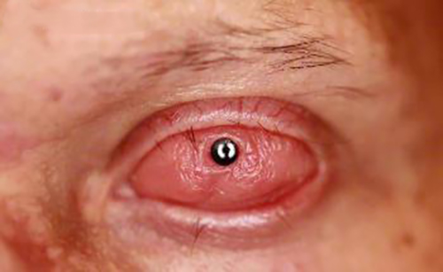 Osteo-odonto-keratoprosthesis (OOKP) (also known as "tooth in eye" 

surgery) is a medical procedure to restore vision in the most severe 

cases of corneal and ocular surface patients. It includes removal of 

a tooth from the patient or a donor. After removal, a lamina of 

tissue cut from the tooth is drilled and the hole is fitted with 

optics. The lamina is grown in the patients' cheek for a period of 

months and then is implanted upon the eye.