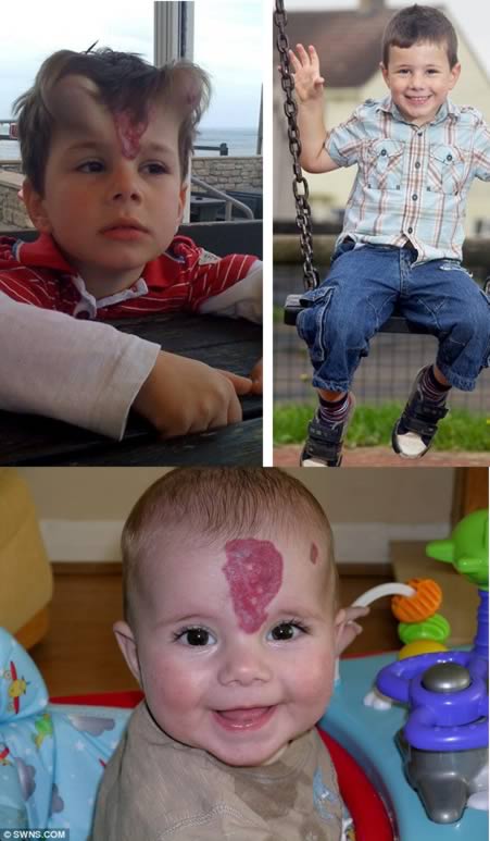 Doctors have treated a young boy with a large birthmark on his face… 

by implanting horns in his forehead. After four months the implants 

were removed and the blemish was cut out, allowing the new skin to be 

stitched together.