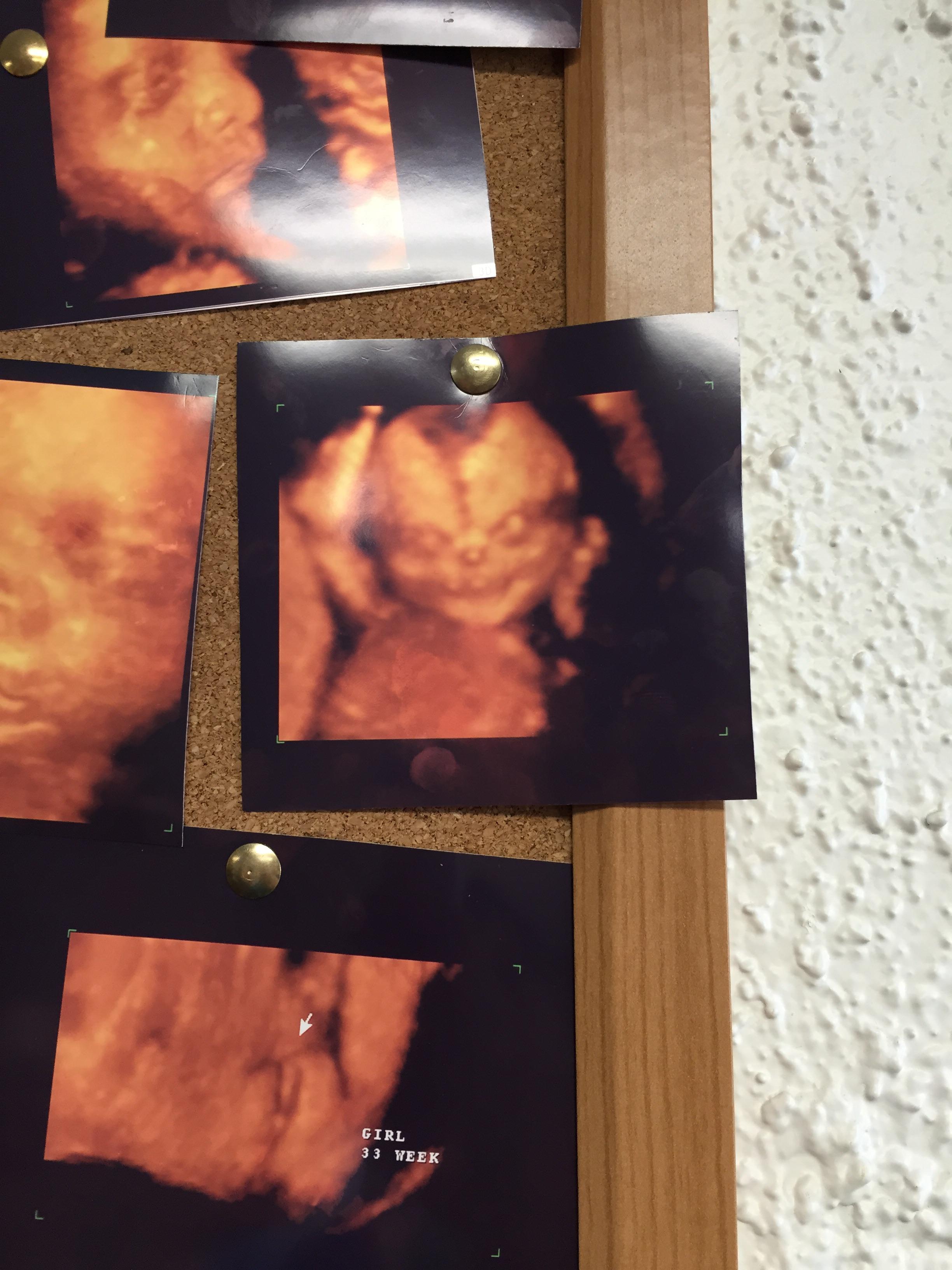 4d ultrasound at 10 weeks