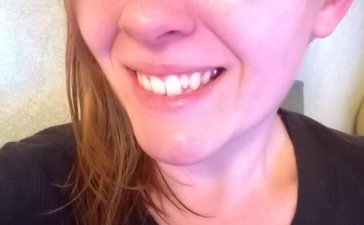 One of this woman's adult teeth never came in...so she's stuck with 

a baby tooth.