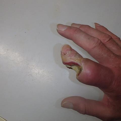 Western Diamondback Rattlesnake Bite Progression