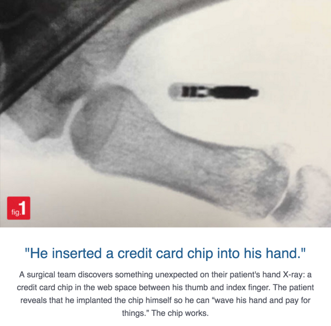 medical imaging - "He inserted a credit card chip into his hand." A surgical team discovers something unexpected on their patient's hand Xray a credit card chip in the web space between his thumb and index finger. The patient reveals that he implanted the