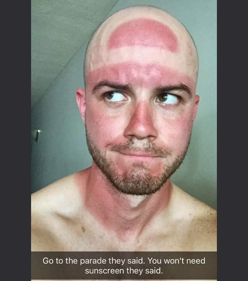 funny sunburns - Go to the parade they said. You won't need sunscreen they said.