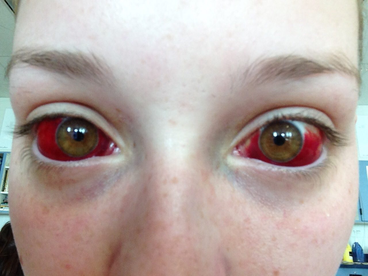 burst blood vessel in eye from vomiting - ..