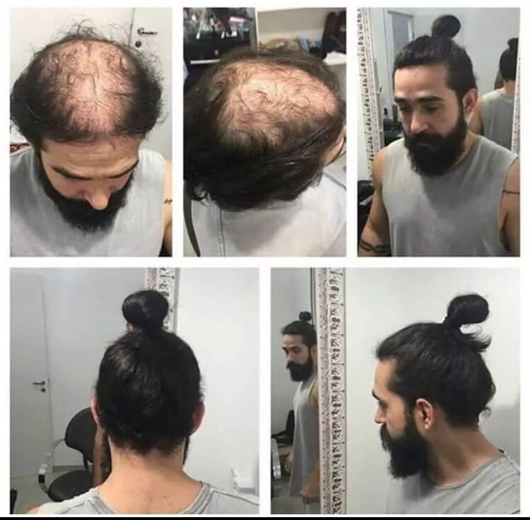 man bun to cover bald spot