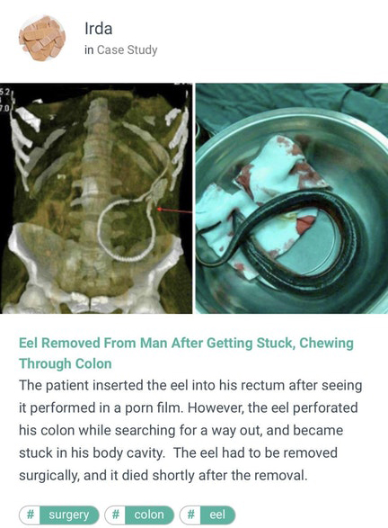 Irda in Case Study Eel Removed From Man After Getting Stuck, Chewing Through Colon The patient inserted the eel into his rectum after seeing it performed in a porn film. However, the eel perforated his colon while searching for a way out, and became stuck