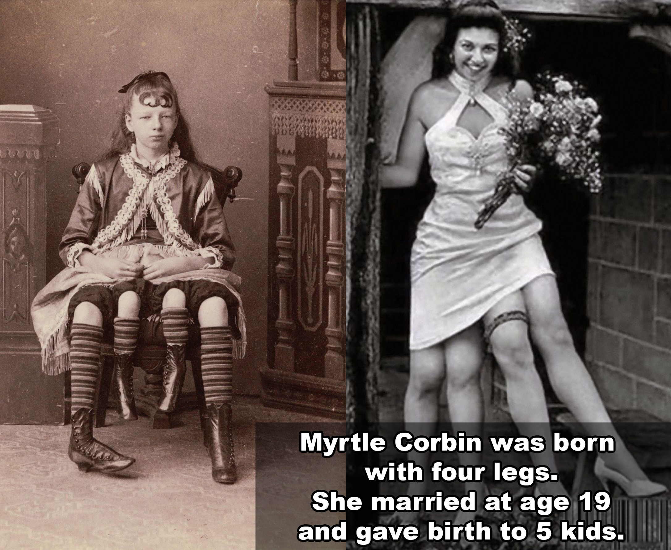 human skeleton barnum - Myrtle Corbin was born with four legs. She married at age 19 and gave birth to 5 kids.