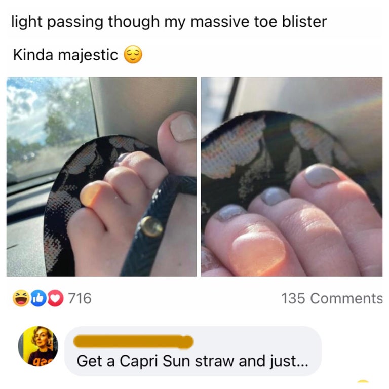 nail - light passing though my massive toe blister Kinda majestic Do 716 135 92 Get a Capri Sun straw and just...