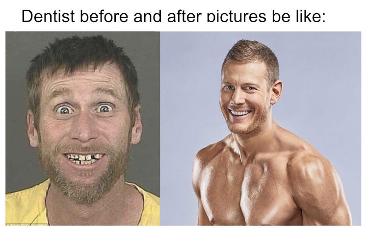 funny memes - barechestedness - Dentist before and after pictures be