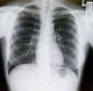 xray lungs