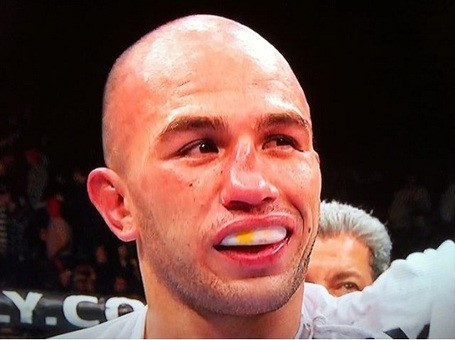 Before the fight his nose looked normal.