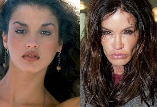 botched surgery janice dickinson before after