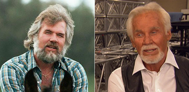 botched surgery kenny rogers plastic surgery