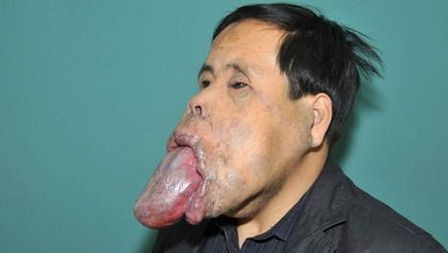 25 inch long tongue of Chinese Wang Youping. He's been unable to open his mouth for 21 years.