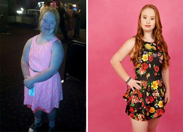 Down Syndrome Teen Wants to be a Model
