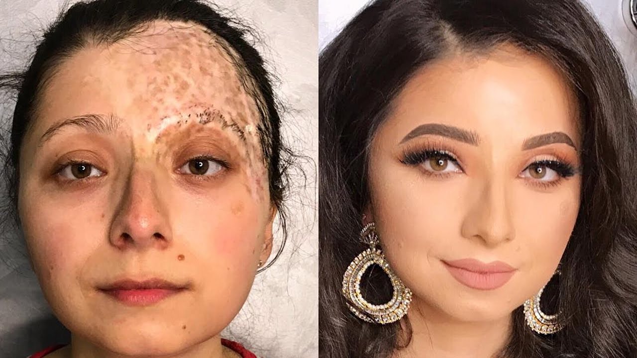 Power of Makeup on Deformities and Scars