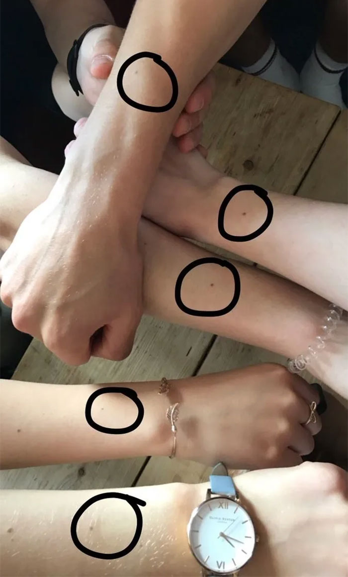 An entire group of friends have virtually the exact same freckle placement.