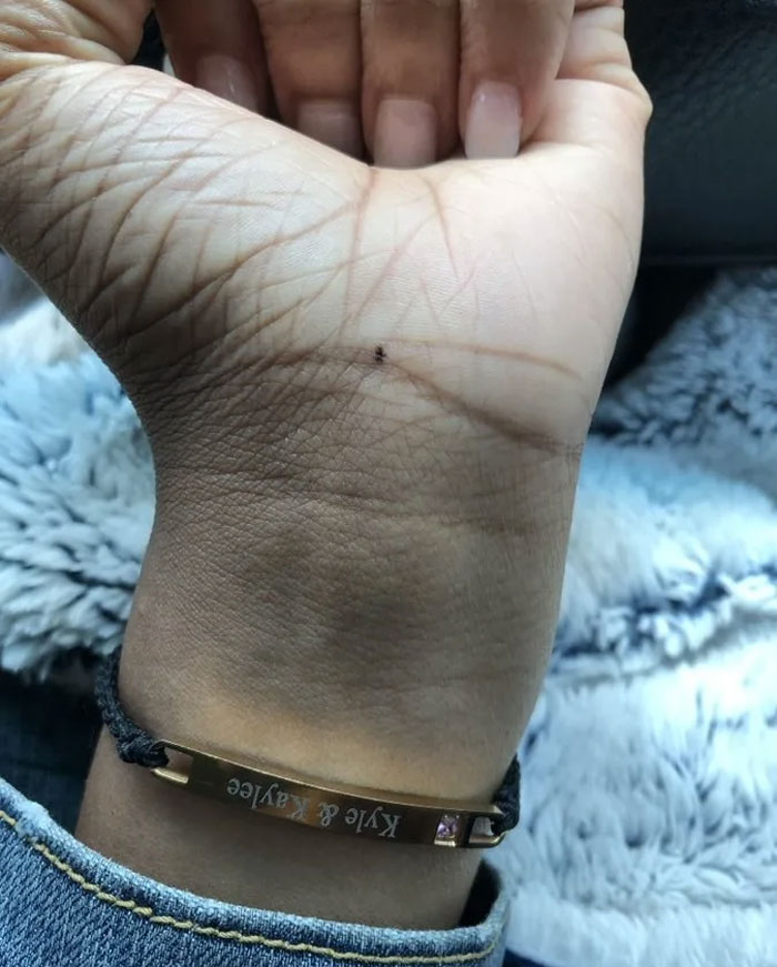 A smaller number of women who don't have a freckle on their outer wrist are instead noticing distinct freckles on the inside.
